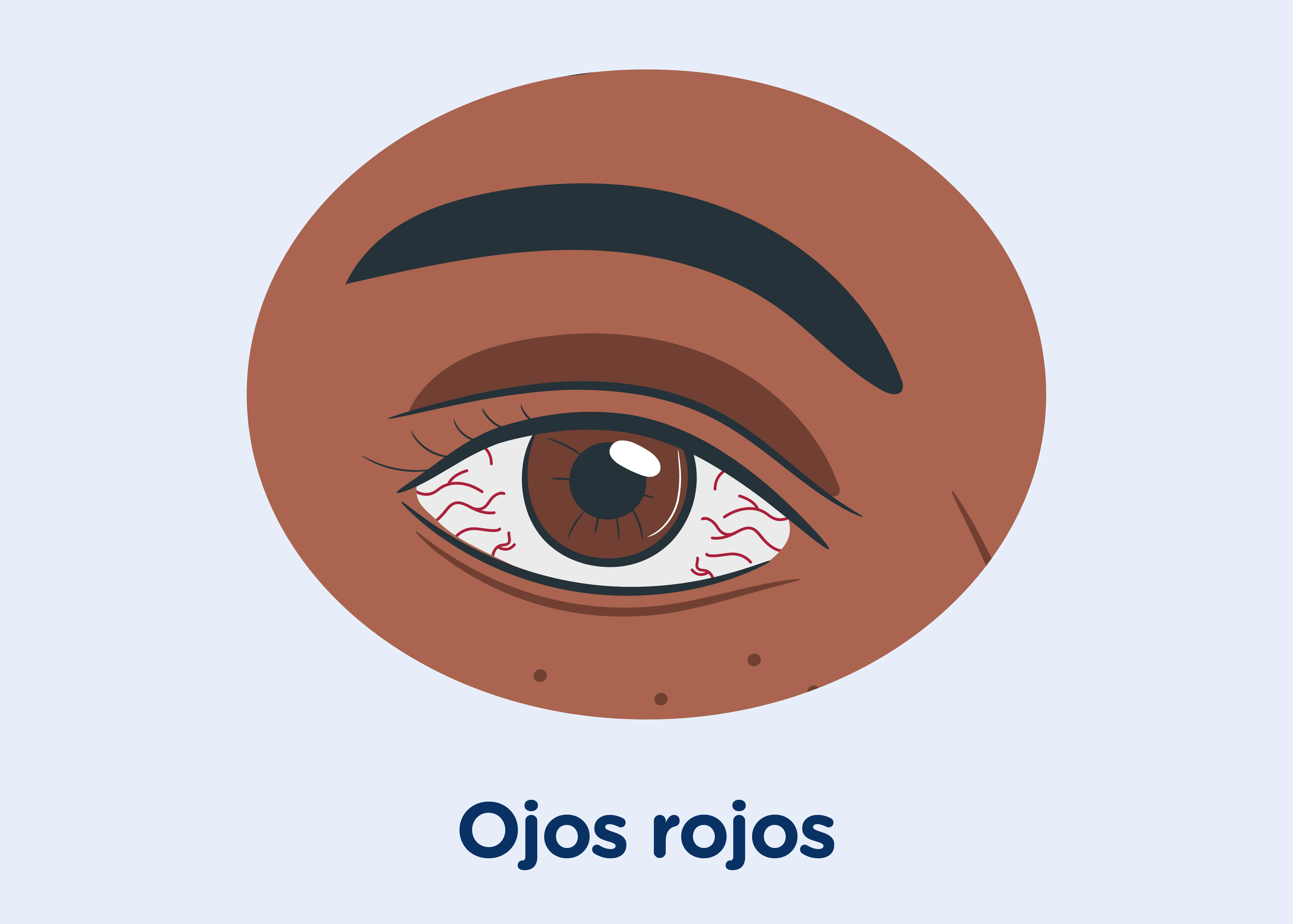 Ojos rojos por conjuntivitis del sarampión — síntoma temprano